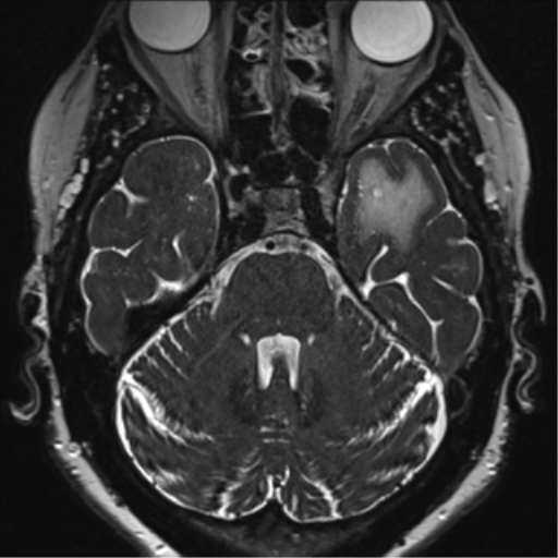 File:Anterior temporal pole cysts (Radiopaedia 46629-51102 Axial 22).png