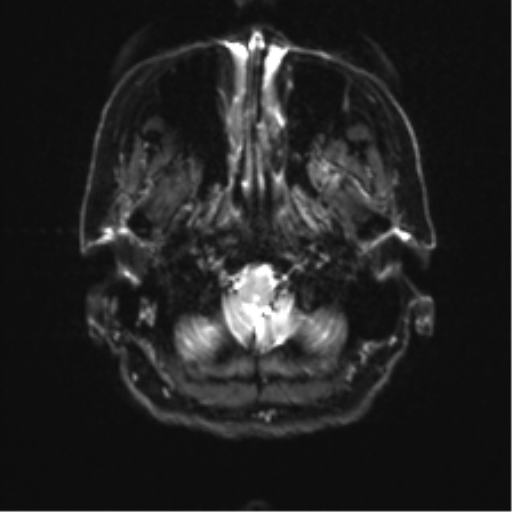 Anterior temporal pole cysts (Radiopaedia 46629-51102 Axial DWI 3).png