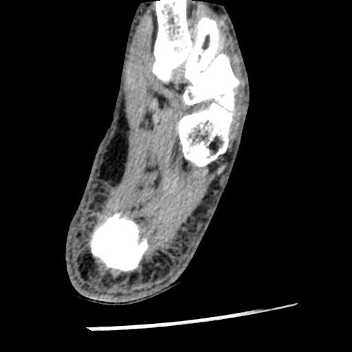 Anterior tibial artery false aneurysm (Radiopaedia 88984-105809 A 212).jpg