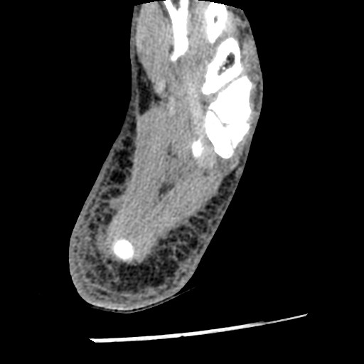 File:Anterior tibial artery false aneurysm (Radiopaedia 88984-105809 A 223).jpg