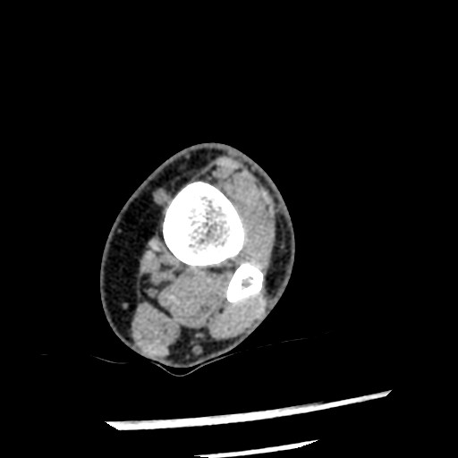 Anterior tibial artery false aneurysm (Radiopaedia 88984-105809 A 63).jpg