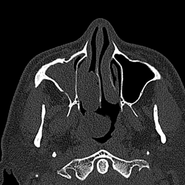Antrochoanal polyp (Radiopaedia 30002-30554 Axial bone window 20).jpg