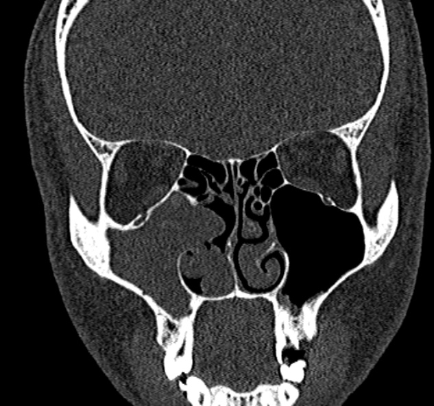Antrochoanal polyp (Radiopaedia 30002-30554 Coronal bone window 38).jpg