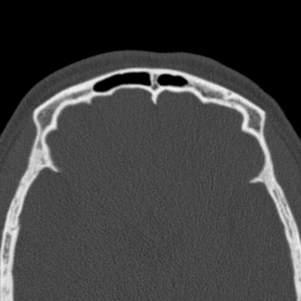 Antrochoanal polyp (Radiopaedia 33984-35202 Axial bone window 73).jpg