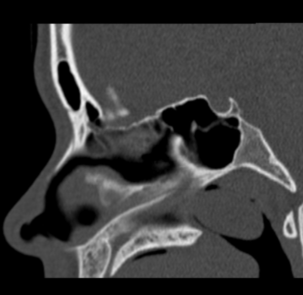 Antrochoanal polyp (Radiopaedia 33984-35202 Sagittal bone window 43).jpg