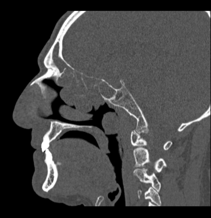 Antrochoanal polyp (Radiopaedia 79011-92169 Sagittal bone window 38).jpg