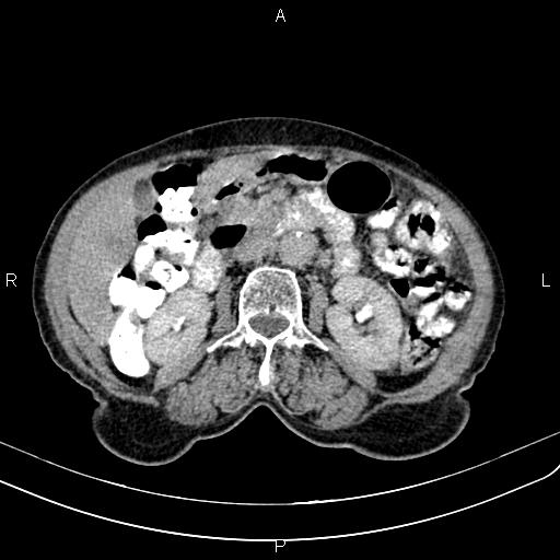 Aortic aneurysm and Lemmel syndrome (Radiopaedia 86499-102554 Axial C+ delayed 35).jpg