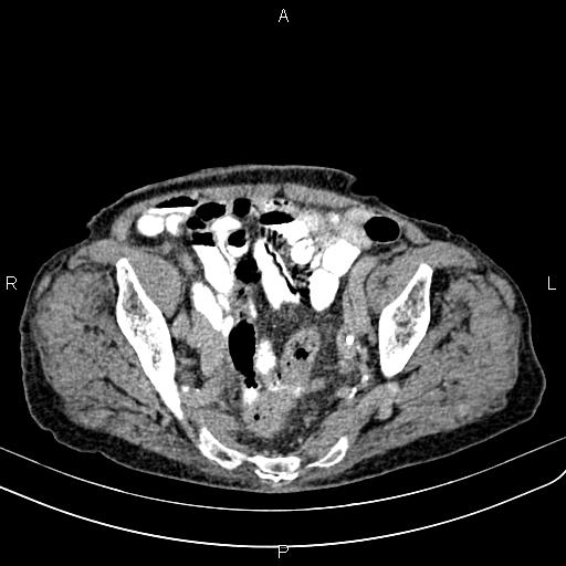 File:Aortic aneurysm and Lemmel syndrome (Radiopaedia 86499-102554 Axial C+ delayed 65).jpg