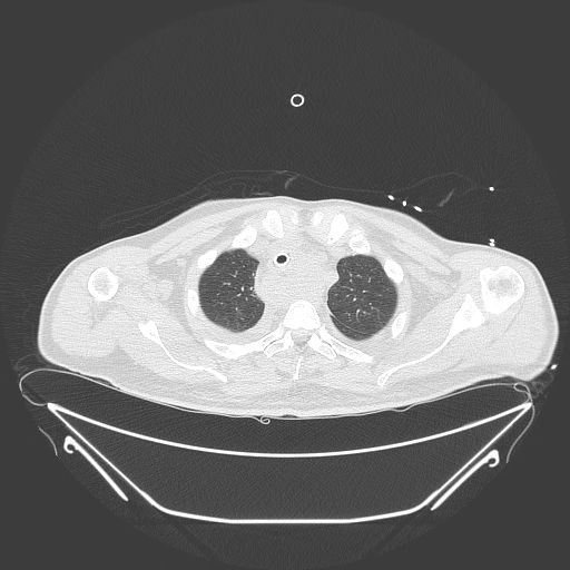 Aortic arch aneurysm (Radiopaedia 84109-99365 Axial lung window 63).jpg