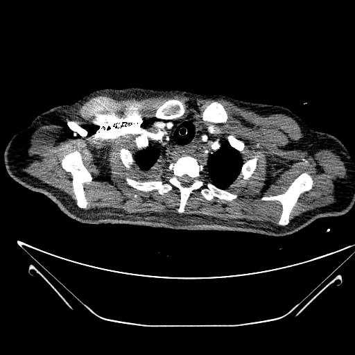 Aortic arch aneurysm (Radiopaedia 84109-99365 B 80).jpg