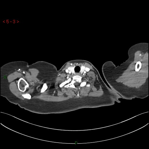 Aortic arch origin of left vertebral artery (Radiopaedia 51520-57286 A 2).jpg