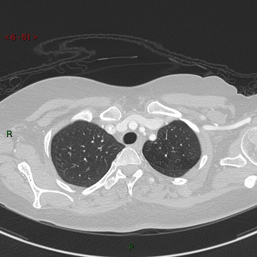 File:Aortic arch origin of left vertebral artery (Radiopaedia 51520-57286 Axial lung window 51).jpg