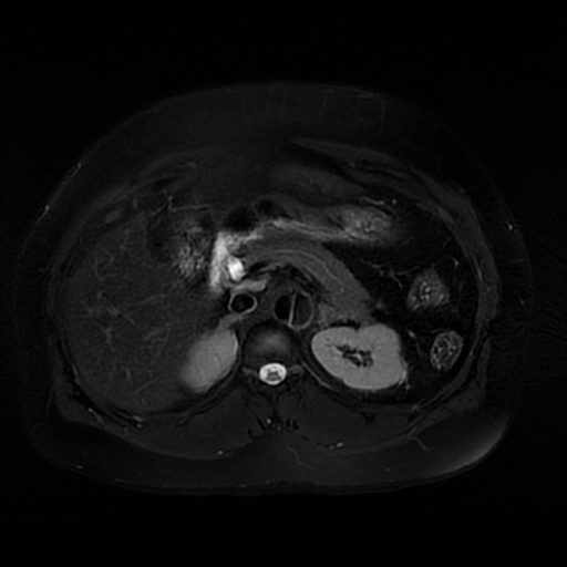 File:Aortic dissection (Radiopaedia 57969-64956 Axial T2 fat sat 26).jpg