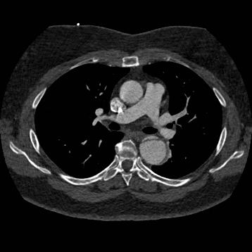 File:Aortic dissection (Radiopaedia 57969-64959 A 139).jpg