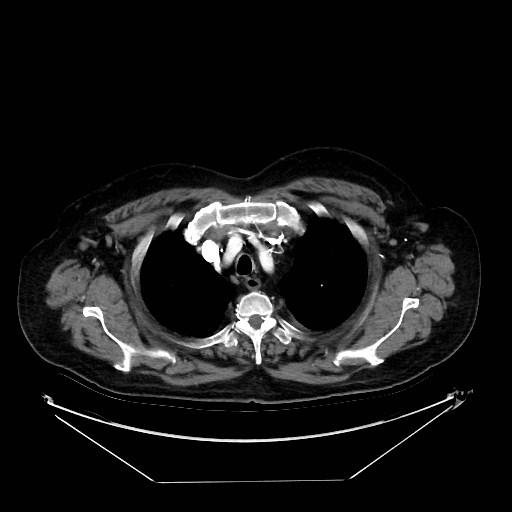 Aortic dissection (Radiopaedia 62562-71000 A 1).jpg