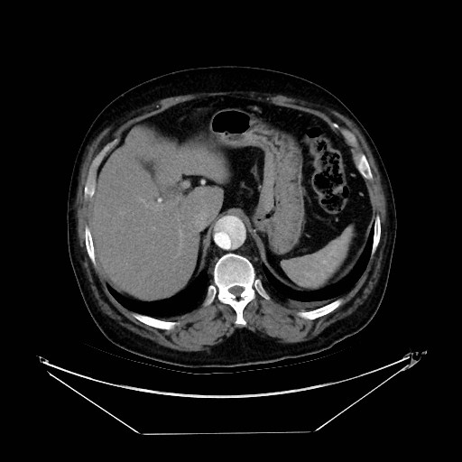Aortic dissection (Radiopaedia 62562-71000 A 46).jpg