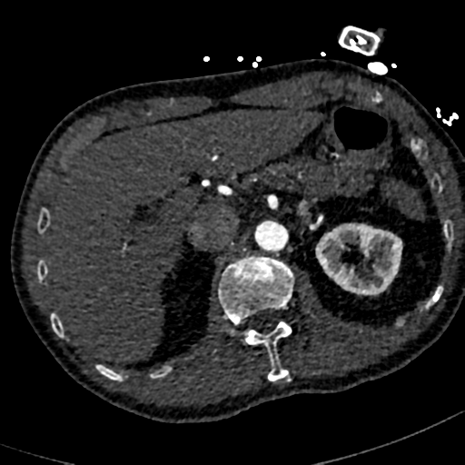 File:Aortic dissection - DeBakey type II (Radiopaedia 64302-73082 A 93).png