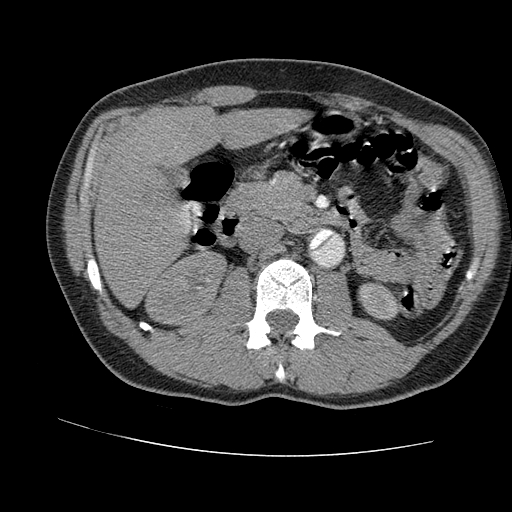 File:Aortic dissection - Stanford A -DeBakey I (Radiopaedia 28339-28587 B 129).jpg