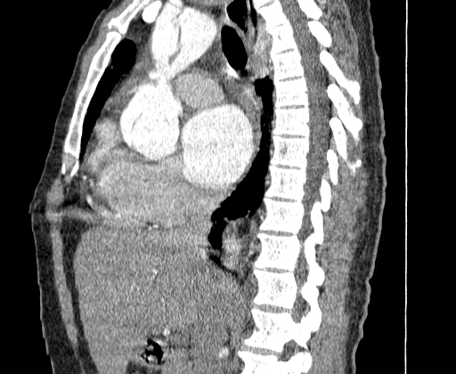 Aortic dissection - Stanford A -DeBakey I (Radiopaedia 28339-28587 C 21).jpg