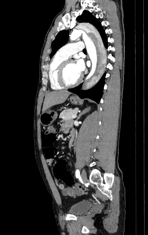 Aortic dissection - Stanford type A (Radiopaedia 83418-98500 B 52).jpg