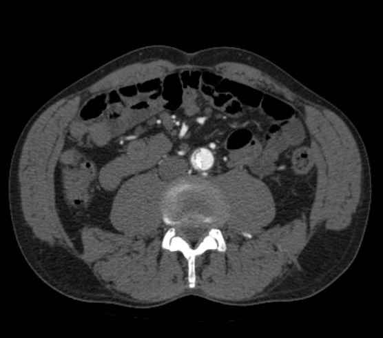 Aortic dissection - Stanford type B (Radiopaedia 73648-84437 A 180).jpg