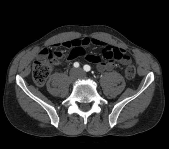 Aortic dissection - Stanford type B (Radiopaedia 73648-84437 A 203).jpg