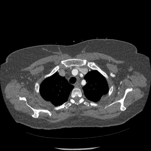 Aortic dissection - Stanford type B (Radiopaedia 88281-104910 A 9).jpg