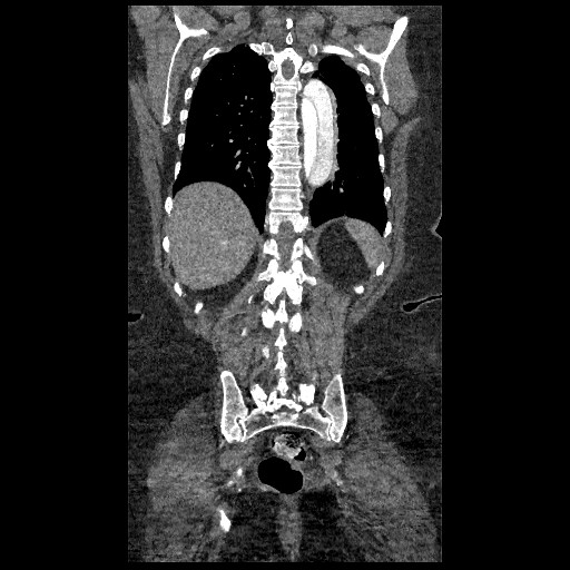 File:Aortic dissection - Stanford type B (Radiopaedia 88281-104910 B 69).jpg