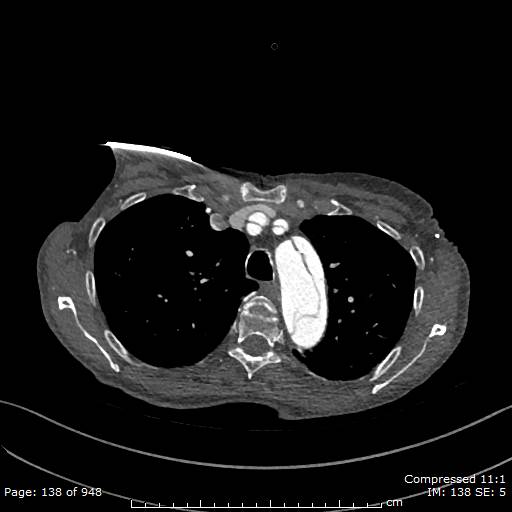File:Aortic dissection with extension into aortic arch branches (Radiopaedia 64402-73204 B 138).jpg