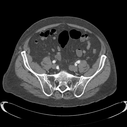 Aortic intramural hematoma (Radiopaedia 34260-35540 B 76).png