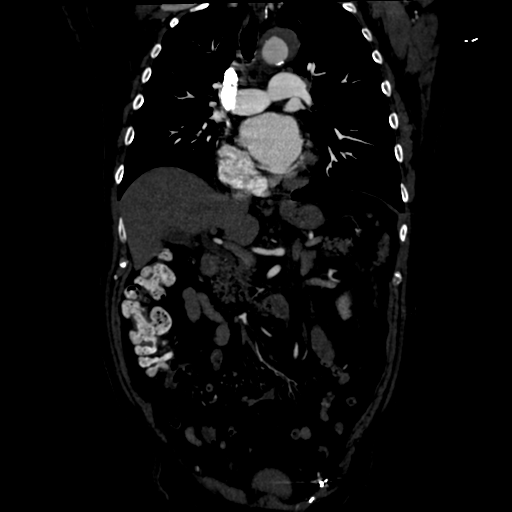 Aortic intramural hematoma (Radiopaedia 34260-35540 C 40).png