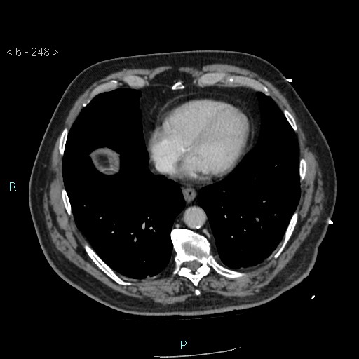 File:Aortic intramural hematoma (Radiopaedia 48463-53380 C 112).jpg