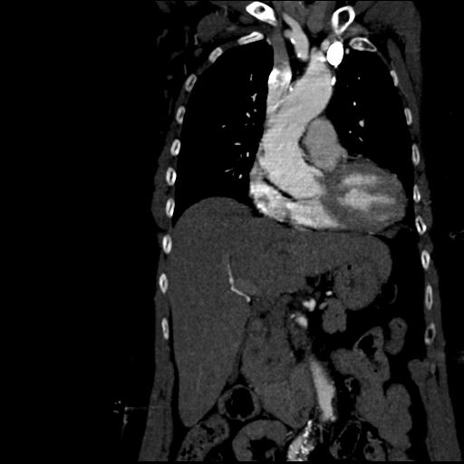 Aortic intramural hematoma from penetrating atherosclerotic ulcer (Radiopaedia 31137-31836 C 24).jpg