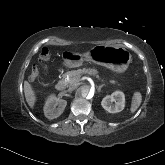Aortic intramural hematoma with dissection and intramural blood pool (Radiopaedia 77373-89491 B 117).jpg