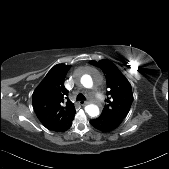 Aortic intramural hematoma with dissection and intramural blood pool (Radiopaedia 77373-89491 B 46).jpg