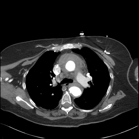 Aortic intramural hematoma with dissection and intramural blood pool (Radiopaedia 77373-89491 B 48).jpg