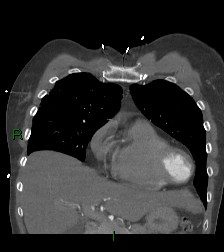 File:Aortic valve endocarditis (Radiopaedia 87209-103485 D 52).jpg