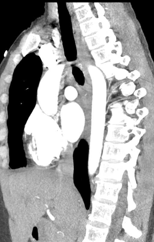 Aortic valve non-coronary cusp thrombus (Radiopaedia 55661-62189 C+ arterial phase 32).png