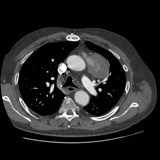 File:Aorto-coronary bypass graft aneurysms (Radiopaedia 40562-43157 A 41).png