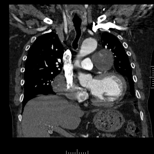 File:Aorto-coronary bypass graft aneurysms (Radiopaedia 40562-43157 B 19).png