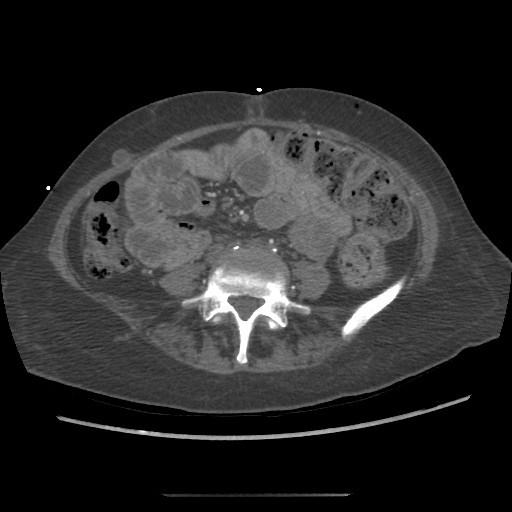 Aorto-duodenal fistula (Radiopaedia 25668-25850 A 51).jpg