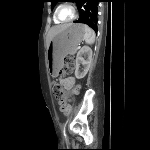 File:Aorto-duodenal fistula (Radiopaedia 25668-25850 C+ arterial phase 17).jpg