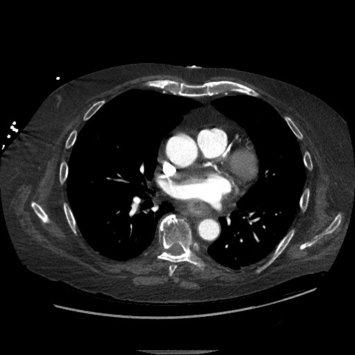 Aortoesophageal fistula with endovascular repair (Radiopaedia 73781-84592 Axial C+ CTPA 84).jpg