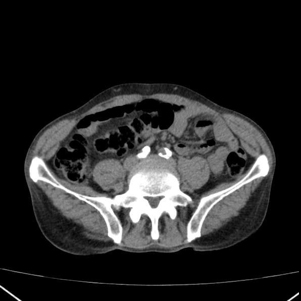 File:Aortoiliac occlusive disease (Radiopaedia 32134-33076 Axial non-contrast 33).jpg