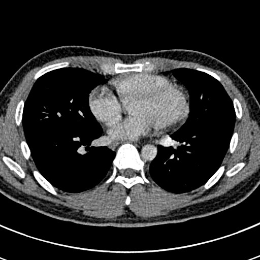 Apical lung mass mimic - neurogenic tumor (Radiopaedia 59918-67521 A 48).jpg