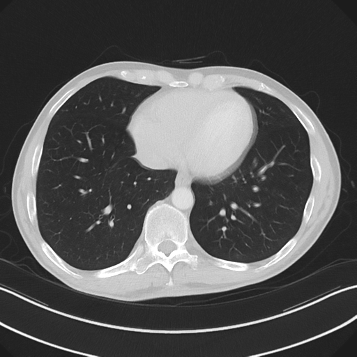 Apical pleural calcification (Radiopaedia 46141-50499 Axial lung window 51).png