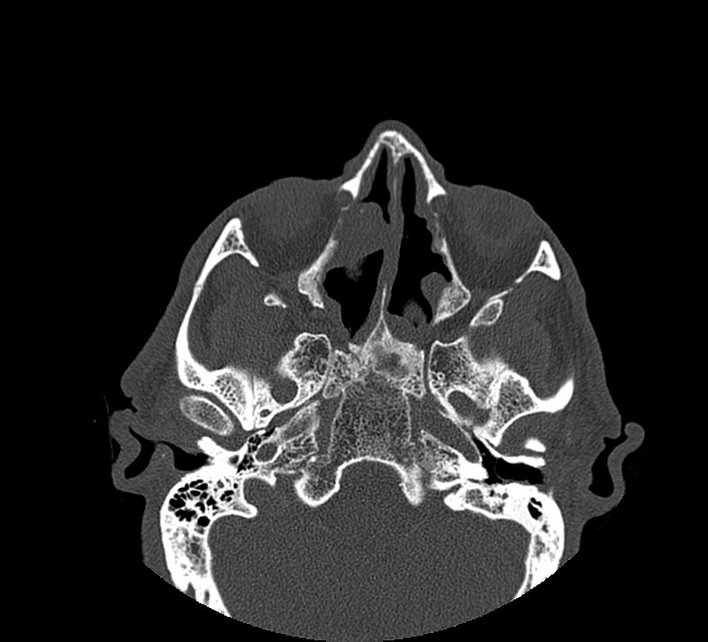 Aplastic maxillary sinuses (Radiopaedia 60030-67561 Axial non-contrast 38).jpg
