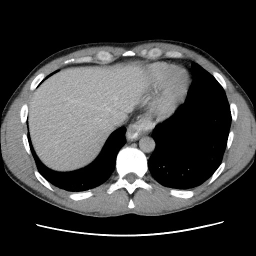 File:Appendicitis complicated by post-operative collection (Radiopaedia 35595-37114 A 12).jpg