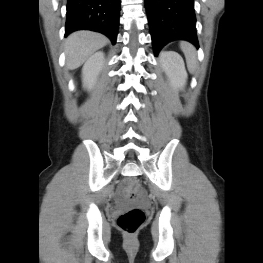 Appendicitis complicated by post-operative collection (Radiopaedia 35595-37114 B 42).jpg