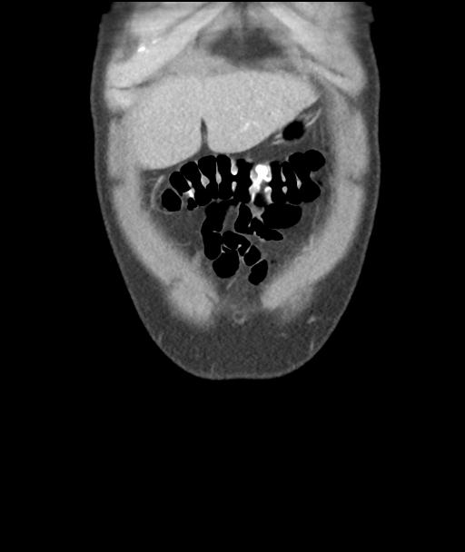 Appendicitis with cecal bar sign (Radiopaedia 31878-32830 A 11).jpg
